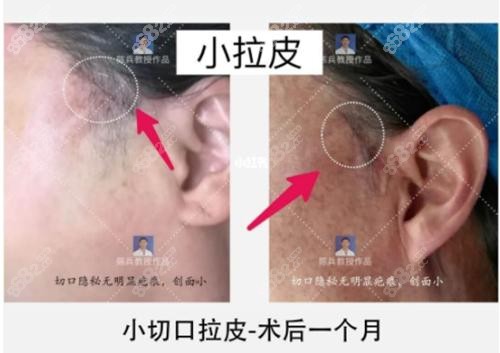 广州<!--<i data=20240705-sp></i>-->医生小拉皮面部除皱