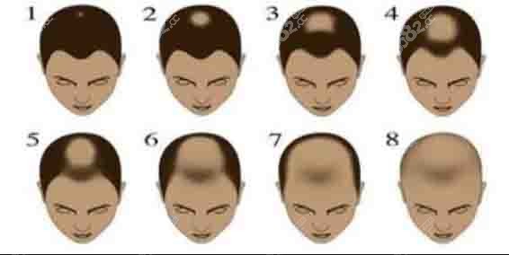 男性脂溢性脱发的过程