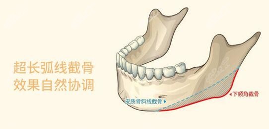 <!--<i data=20240705-sp></i>-->医生做下颌骨手术