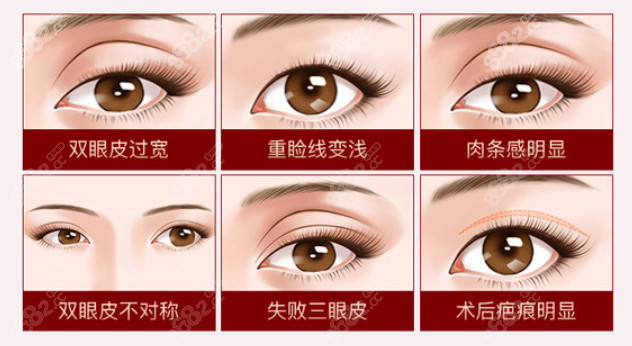 双眼皮失败症状