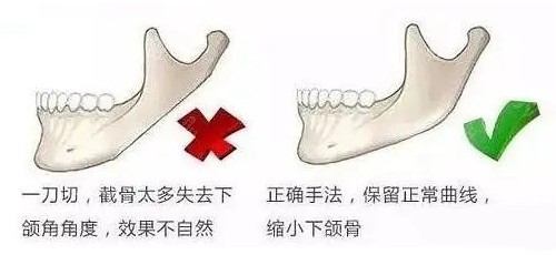 <!--<i data=20240705-sp></i>-->医生下颌角磨骨手术