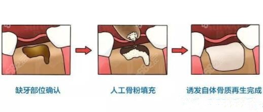 植入骨粉多久之后才能种牙