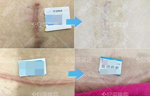 成都欣奕除疤祛除剖腹产凹陷/凸起疤痕前后对比照 成都欣奕除疤祛除剖腹产凹陷/凸起疤痕前后对比照