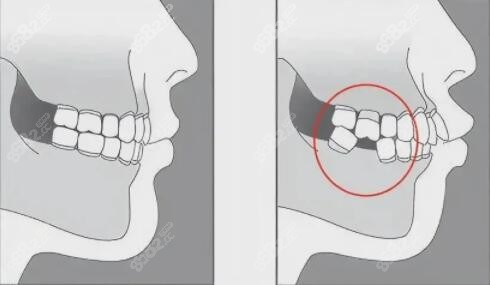 牙缺失多年导致旁边牙齿倾斜