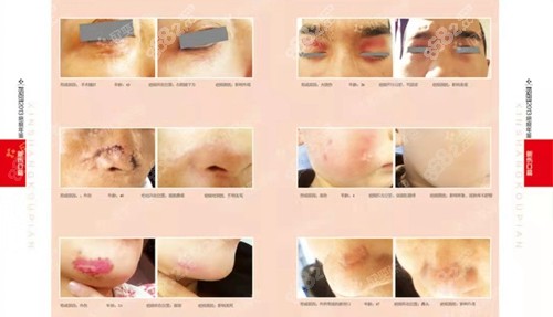 成都欣奕除疤前后对比明显 成都欣奕除疤前后对比明显