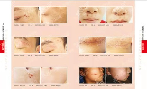 成都欣奕除疤前后对比照 成都欣奕除疤前后对比照