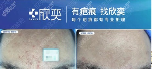 成都欣奕除疤去痘坑前后对比照片 成都欣奕除疤去痘坑前后对比照片