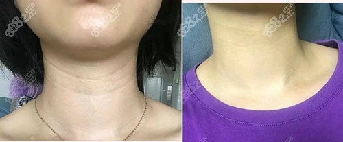 广州健丽嗨体祛颈纹前后对比照 广州健丽嗨体祛颈纹前后对比照