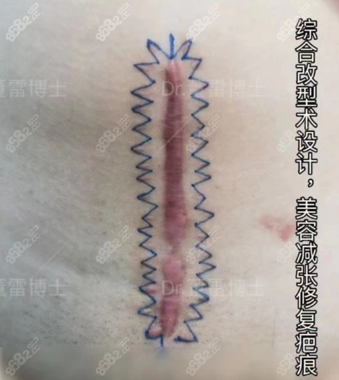 上海清沁董雷博士做刨妇产疤痕疙瘩方案