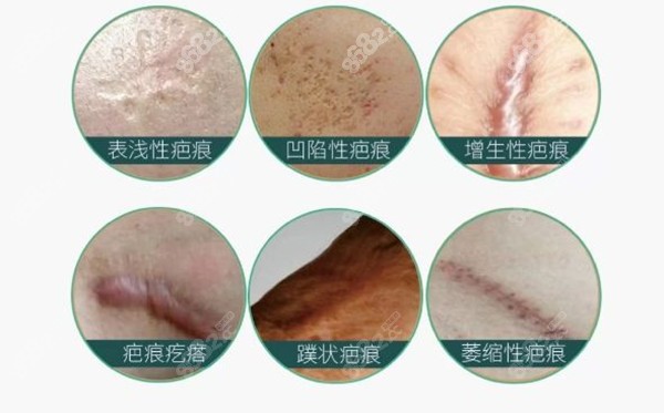 上海清沁医疗美容SRT－100疤痕修复仪器