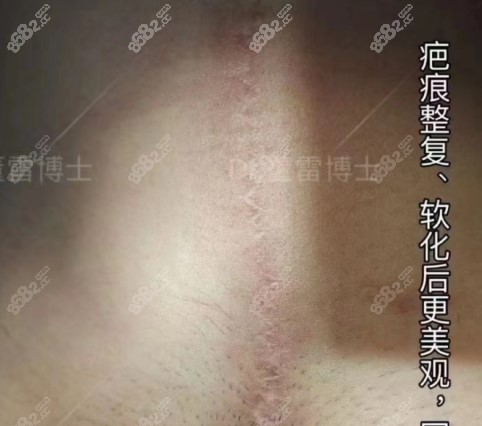 上海清沁董雷博士做刨妇产疤痕疙瘩术后7个月