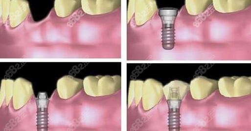 郑州植得口腔医院种植牙价格表