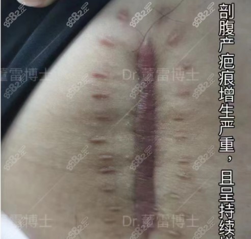 上海清沁董雷博士做刨妇产疤痕疙瘩术前