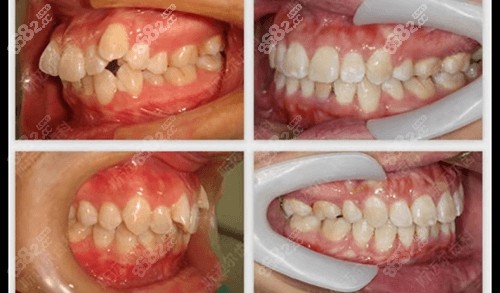 北京斯迈尔口腔牙齿矫正对比照