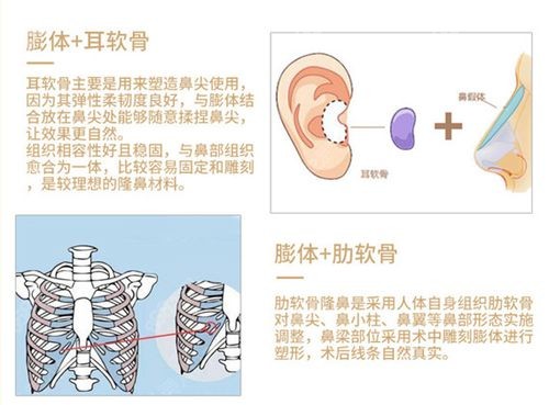 自体软骨隆鼻优势