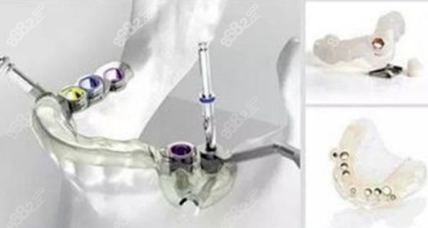 3d數(shù)字化導(dǎo)板種植技術(shù)