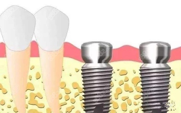 目前較為先進的種植牙技術(shù)是什么？