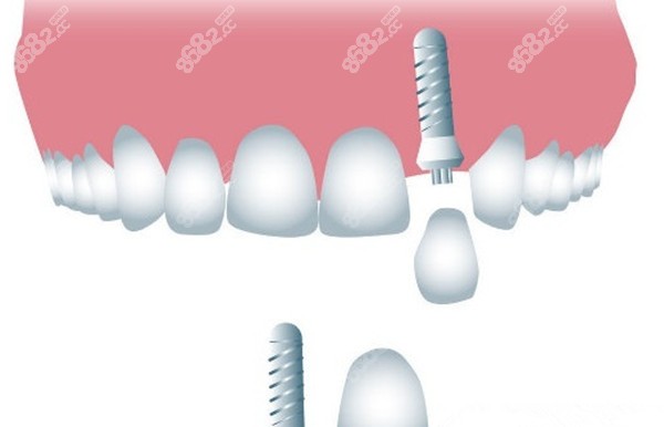 種植牙的技術(shù)在國內(nèi)成熟嗎？