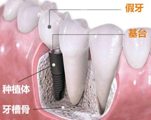 影响种植牙价格的组成部分