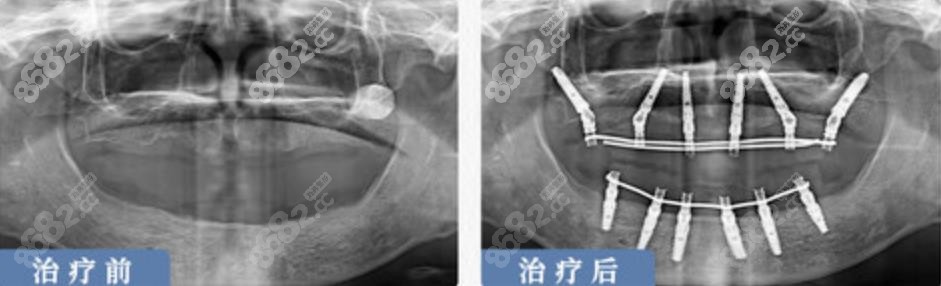 上海鼎植口腔全口种植牙病例分享
