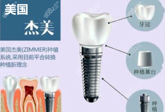 美國zimmer種植牙
