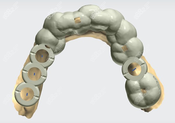 3D数字化导板种植技术