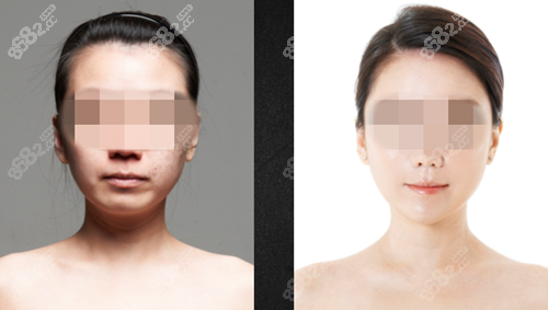 韩国必当归玻尿酸丰面颊的前后对比照 韩国必当归玻尿酸丰面颊的前后对比照