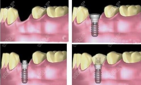种植牙过程示意图