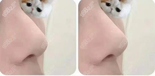 杭州连天美爱贝芙隆鼻前后对比照 杭州连天美爱贝芙隆鼻前后对比照