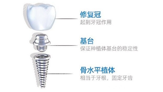 种植体的构成