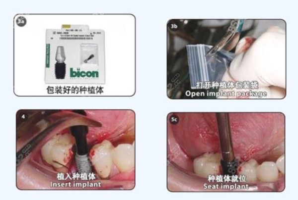 利用百康种植体做种植手术的步骤