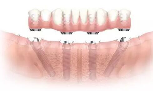 ALL-ON-4半口种植牙