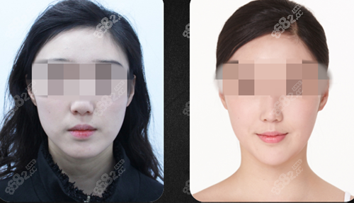 韩国必当归玻尿酸丰面颊的前后对比明显 韩国必当归玻尿酸丰面颊的前后对比明显