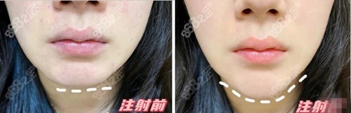 东莞可枚尔玻尿酸丰下巴前后对比明显 东莞可枚尔玻尿酸丰下巴前后对比明显