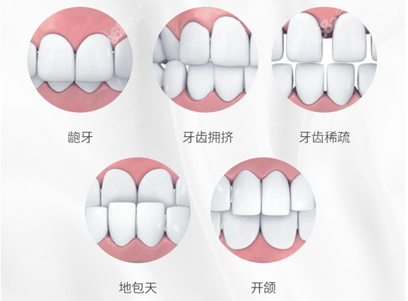 需要做牙齿矫正