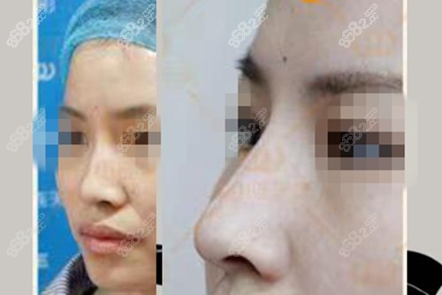 杭州连天美爱贝芙隆鼻前后对比照 杭州连天美爱贝芙隆鼻前后对比照