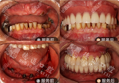 <!--<i data=20240705-sp></i>-->口腔种植牙对比照