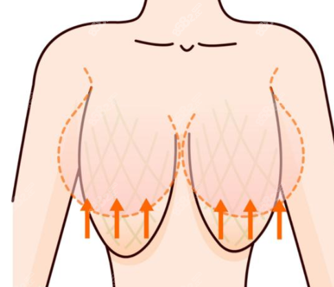 从手术原理了解人工韧带乳房提升有无利弊