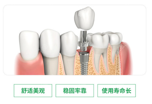 法国安卓健种植牙优势