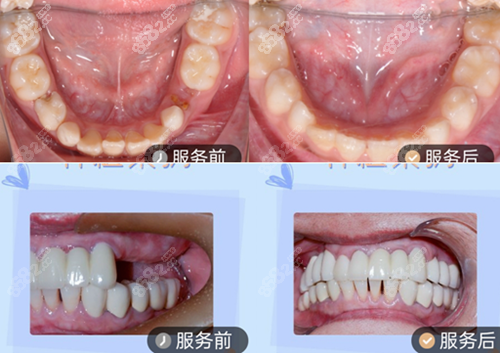 深圳鹏程口腔种植牙对比照