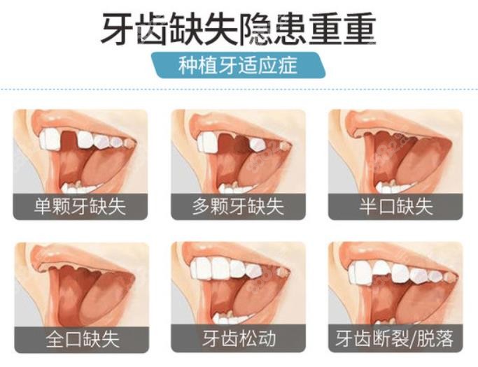 种植牙适应症状