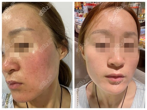 <!--<i data=20240705-sp></i>-->超皮秒祛斑前后对比照 <!--<i data=20240705-sp></i>-->超皮秒祛斑前后对比照