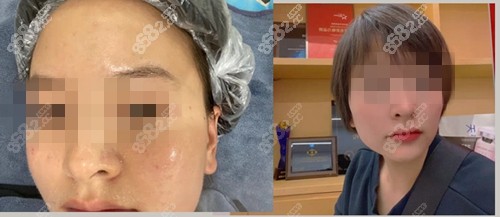 <!--<i data=20240705-sp></i>-->整形医院光子嫩肤前后对比明显 <!--<i data=20240705-sp></i>-->整形医院光子嫩肤前后对比明显