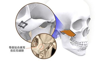 颧骨内推后骨缝修复