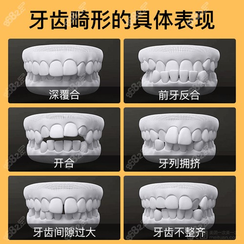 牙齿畸形的集中表现