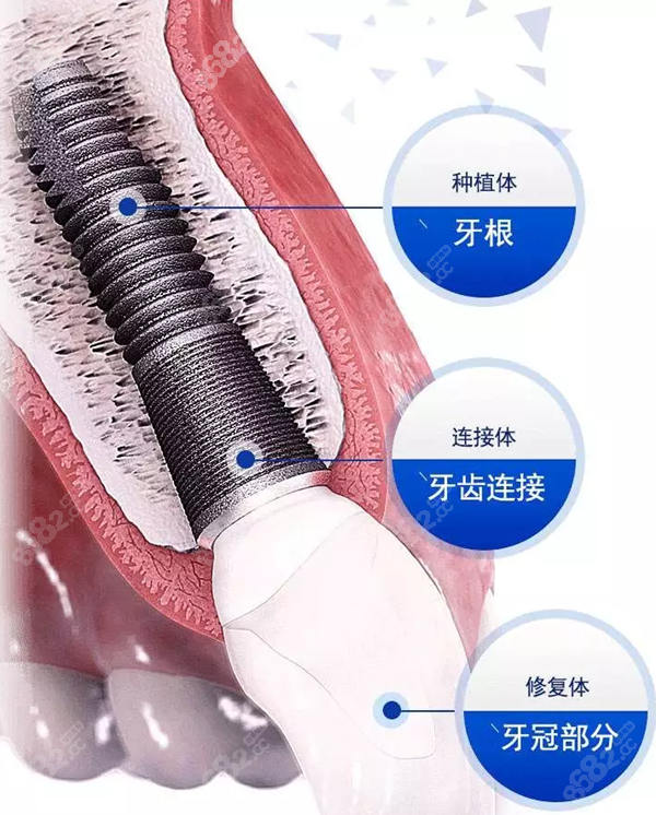 钛锆合金种植体和纯钛种植体的区别