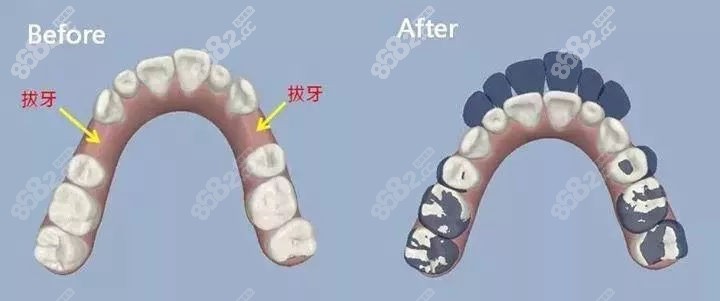 青少年正畸拔牙收缝要恢复多久