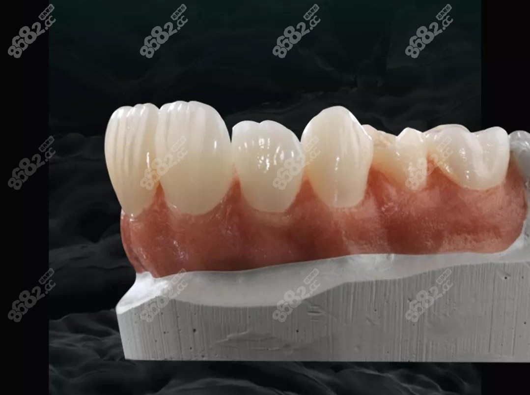 牙医经验之谈——牙齿缺失怎么办？种牙好还是镶牙好？ - 知乎