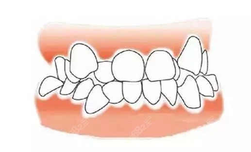正畸拔了4颗牙齿收缝需要多久