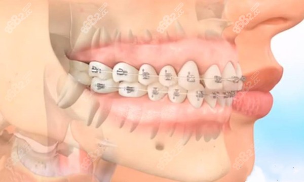 拔4颗4号牙做矫正的副作用